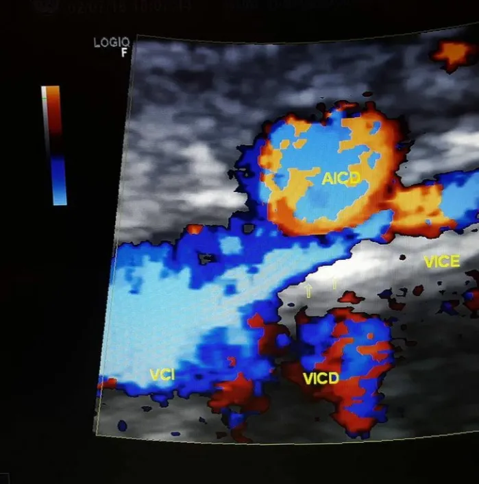 Doppler venoso colorido demonstrando compressão da veia ilíaca comum esquerda, com fluxo colateral