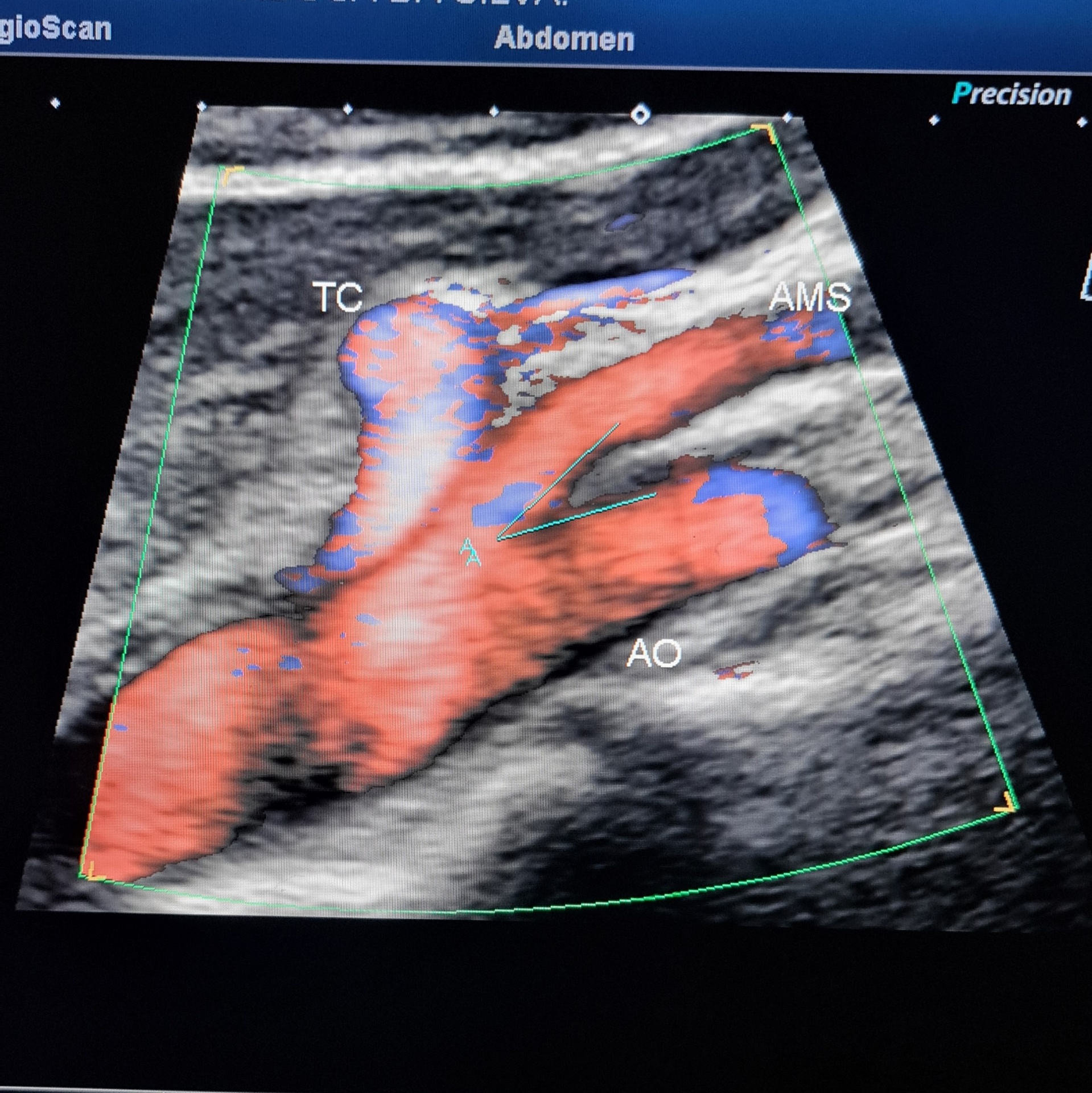 Doppler abdominal com medida do ângulo aorto-mesentérico
