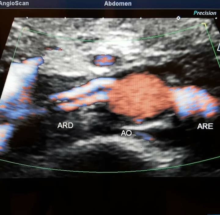 Doppler colorido da aorta abdominal com artérias renais direita e esquerda