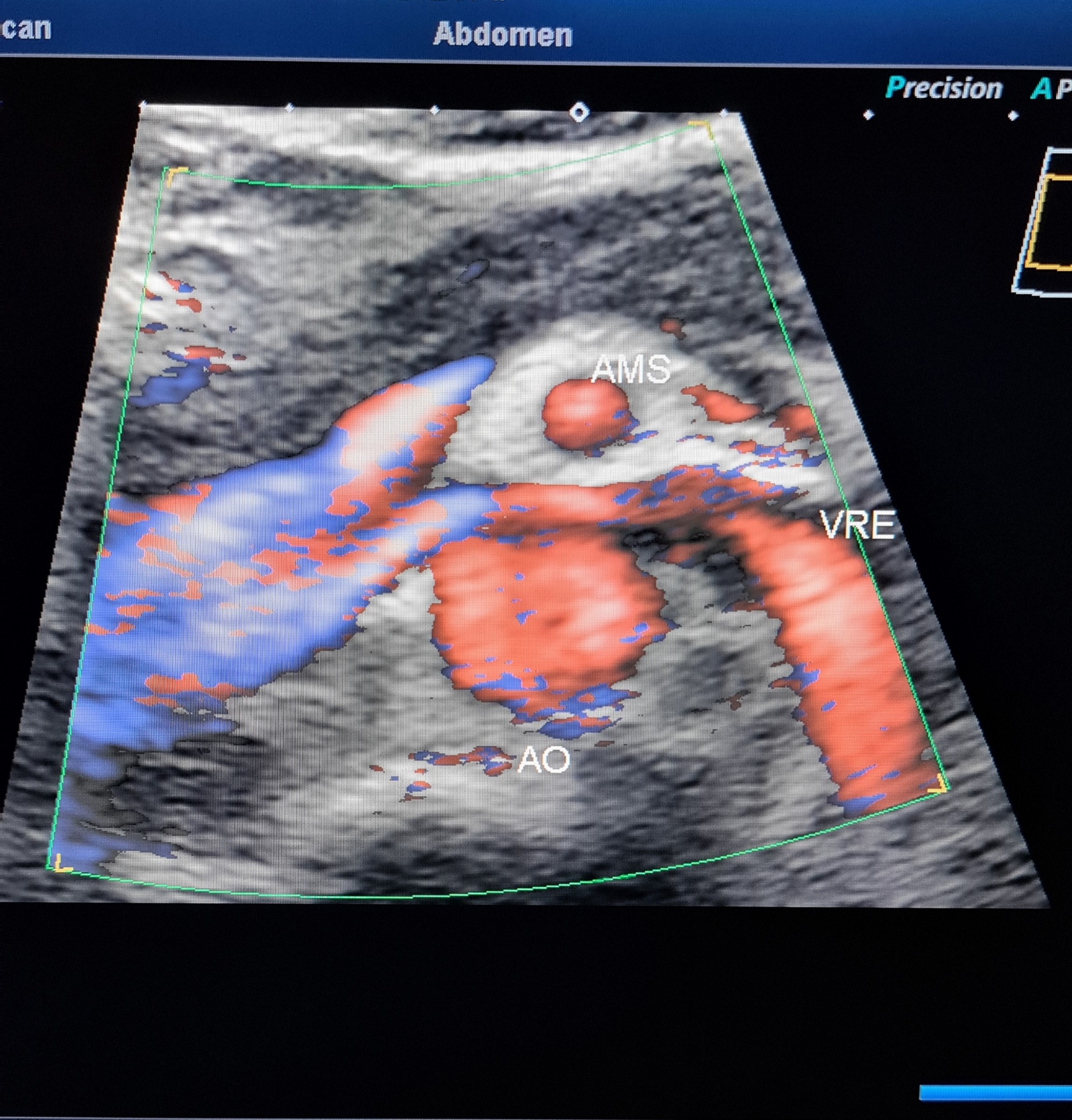 Doppler colorido da veia renal esquerda comprimida entre aorta e artéria mesentérica superior