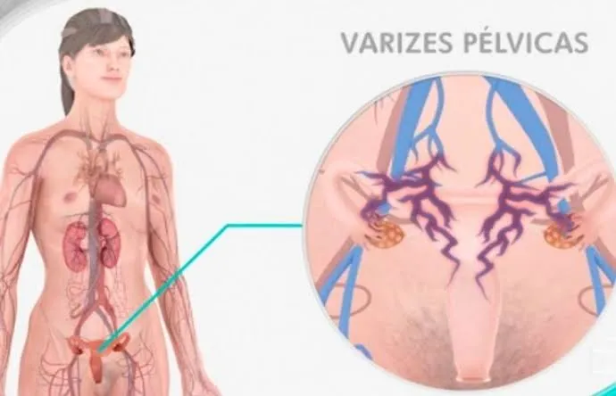 Ilustração médica de varizes pélvicas: dilatação das veias ao redor do útero e dos ovários