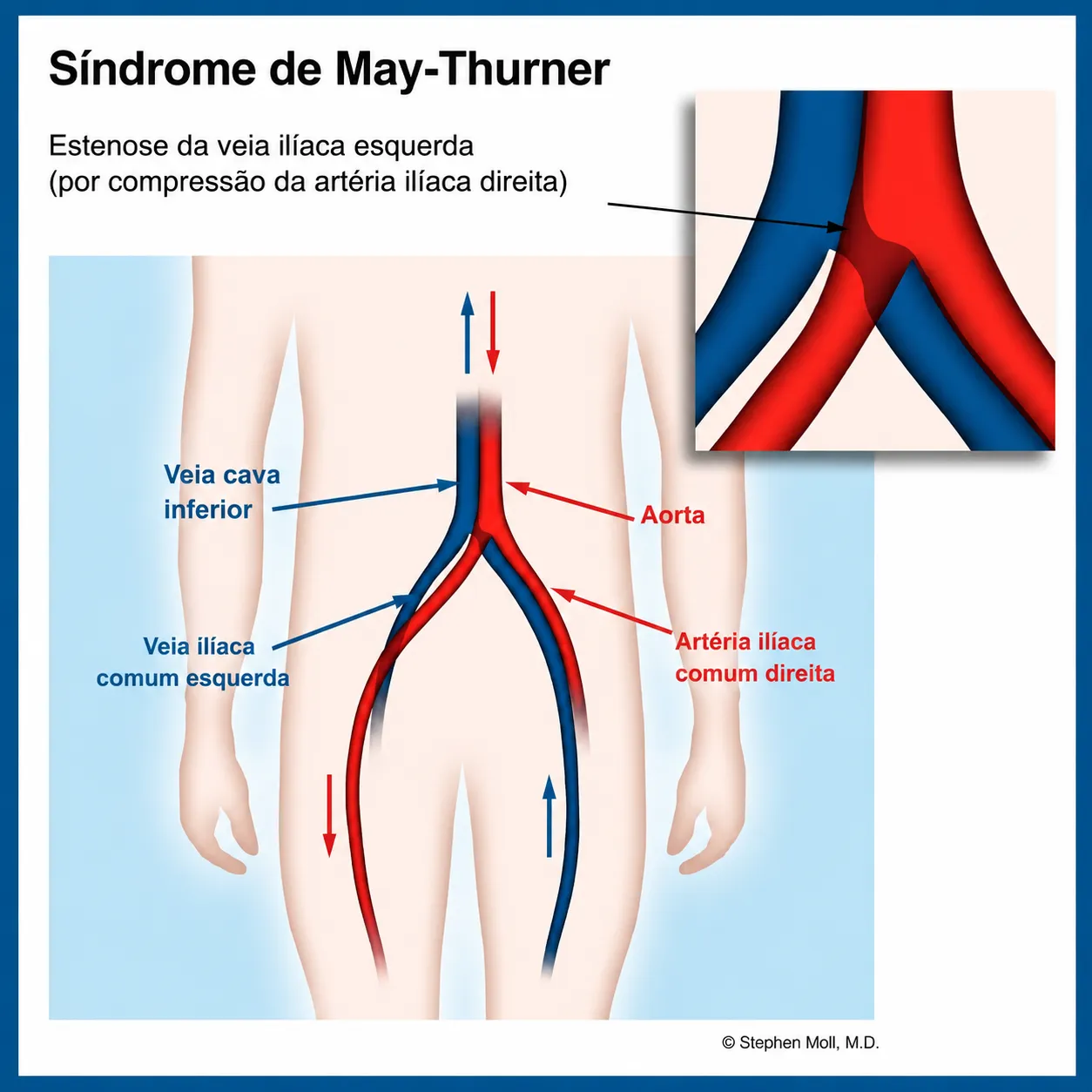 Ilustração da Síndrome de May-Thurner: estenose da veia ilíaca comum esquerda por compressão da artéria ilíaca comum direita