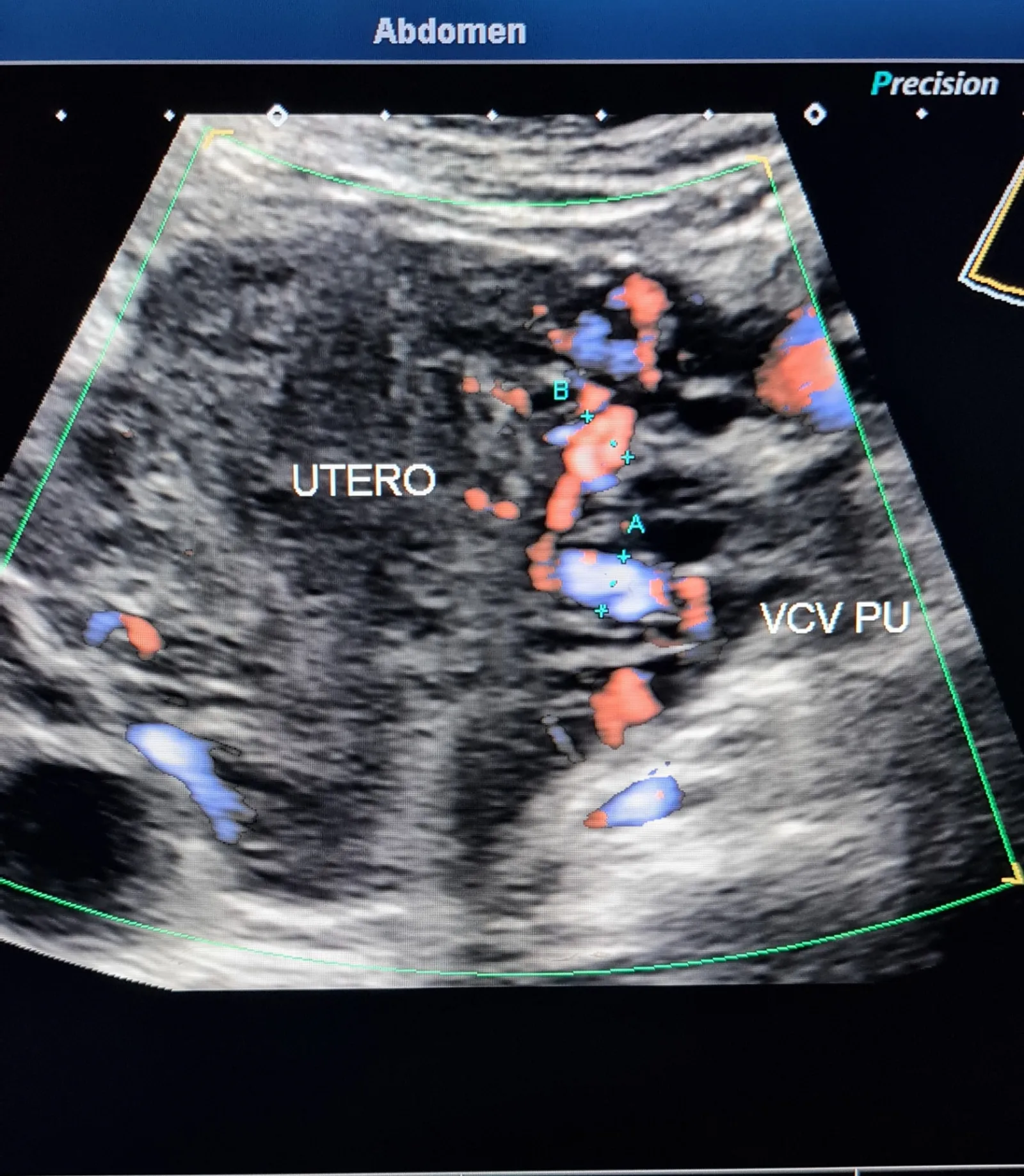 Doppler pélvico mostrando varizes do plexo uterino com medidas