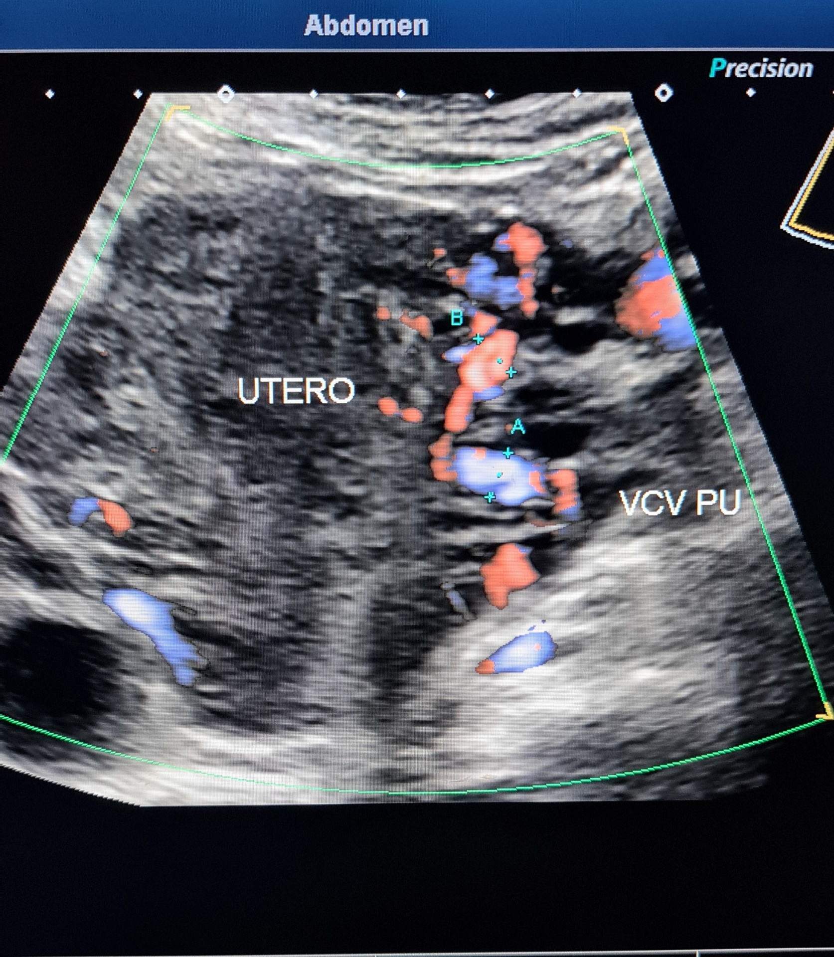 Doppler pélvico mostrando varizes do plexo uterino com medidas